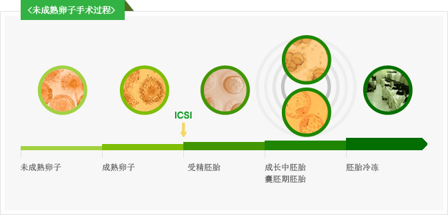 미성숙 난자 시술과정