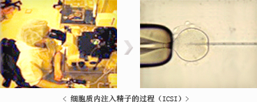 세포질내 정자 주입술(ICSI) 과정 사진